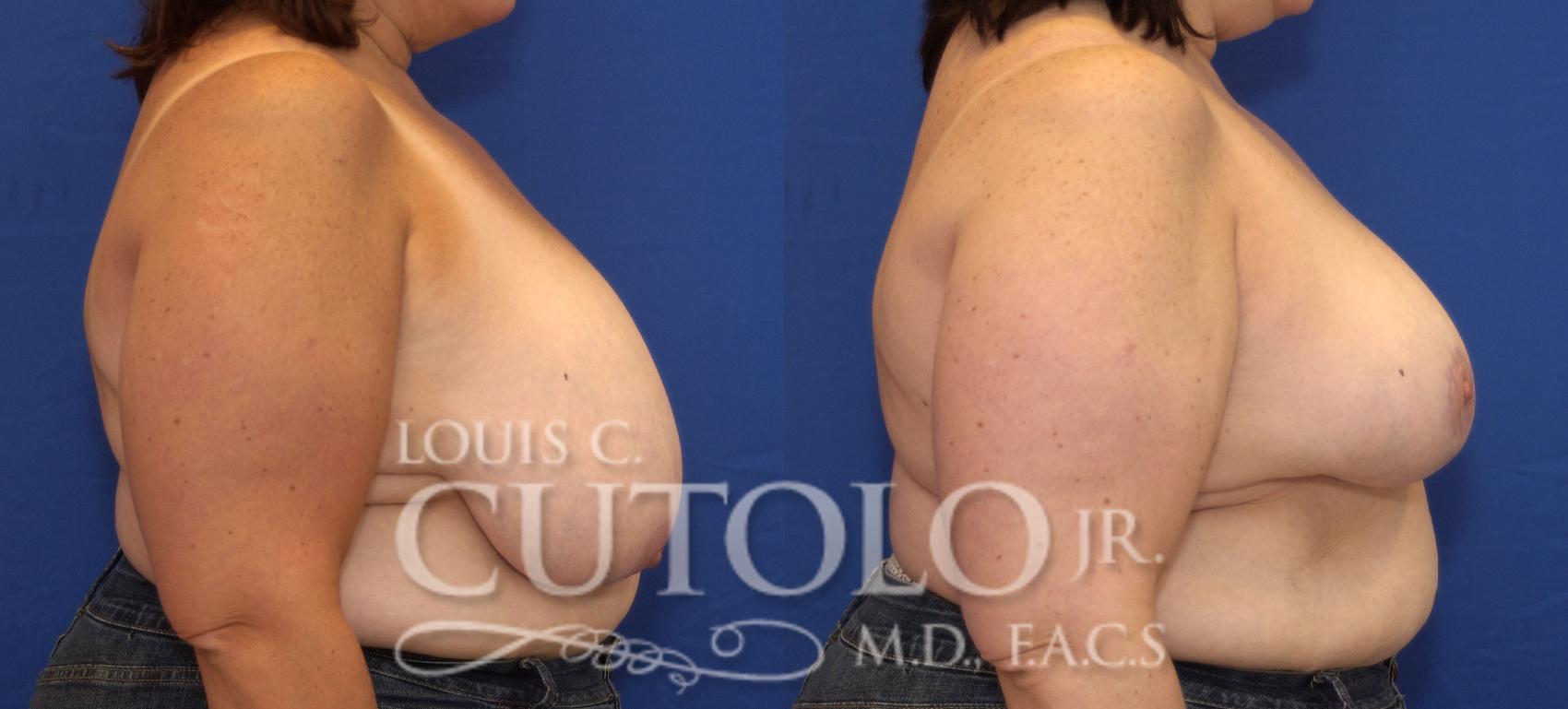 Before & After Breast Reduction Case 112 View #5 View in Brooklyn, Staten Island, Queens, NY
