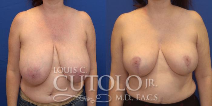 Before & After Breast Reduction Case 161 View #1 View in Brooklyn, Staten Island, Queens, NY