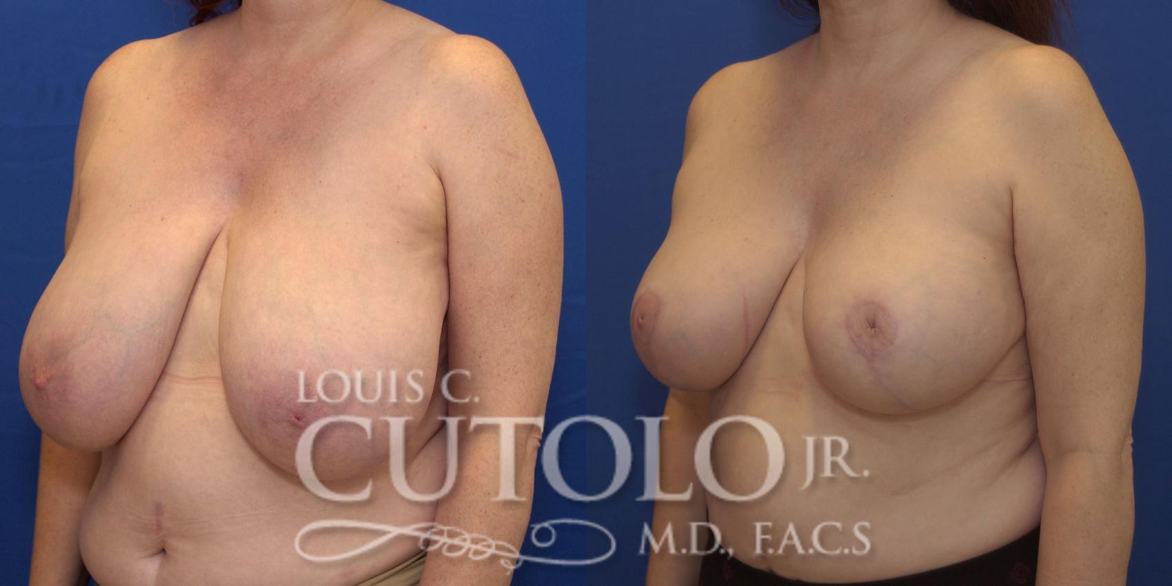 Before & After Breast Reduction Case 161 View #2 View in Brooklyn, Staten Island, Queens, NY