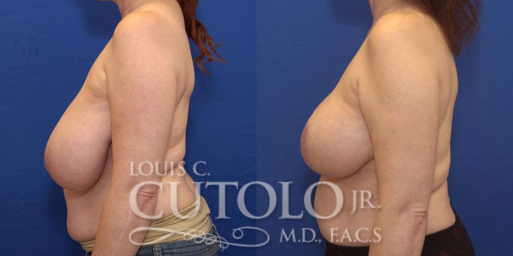 Before & After Breast Reduction Case 161 View #3 View in Brooklyn, Staten Island, Queens, NY
