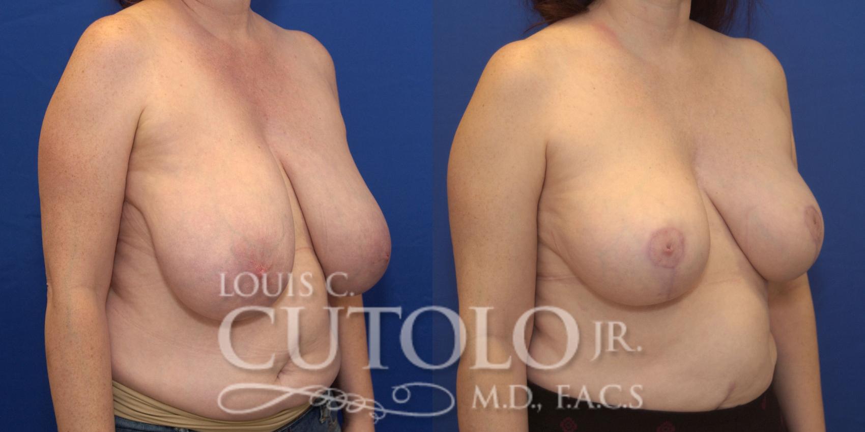 Before & After Breast Reduction Case 161 View #4 View in Brooklyn, Staten Island, Queens, NY