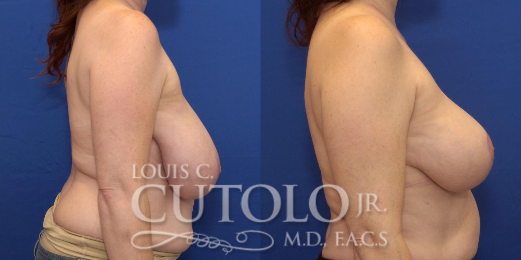Before & After Breast Reduction Case 161 View #5 View in Brooklyn, Staten Island, Queens, NY