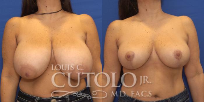 Before & After Breast Reduction Case 168 View #1 View in Brooklyn, Staten Island, Queens, NY