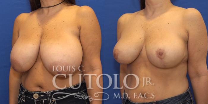 Before & After Breast Reduction Case 168 View #2 View in Brooklyn, Staten Island, Queens, NY