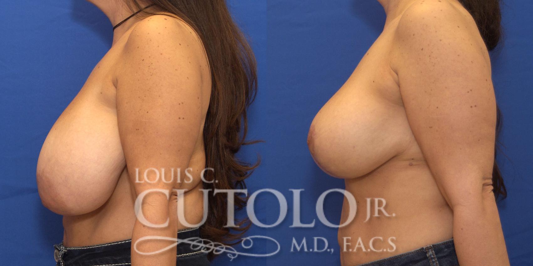 Before & After Breast Reduction Case 168 View #3 View in Brooklyn, Staten Island, Queens, NY