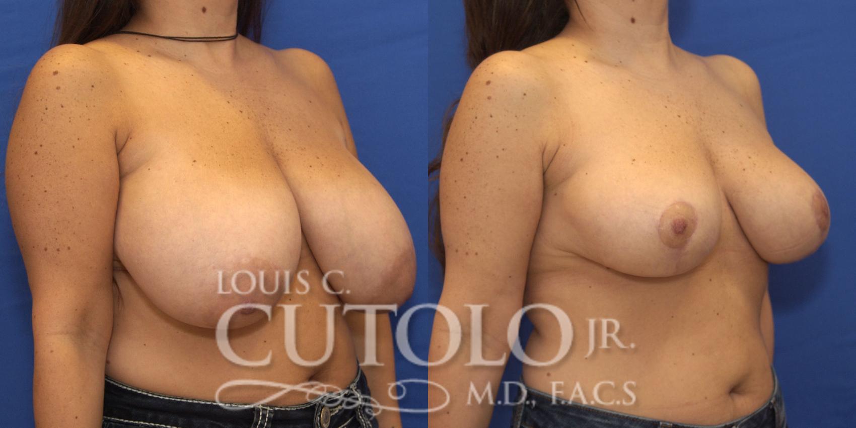 Before & After Breast Reduction Case 168 View #4 View in Brooklyn, Staten Island, Queens, NY