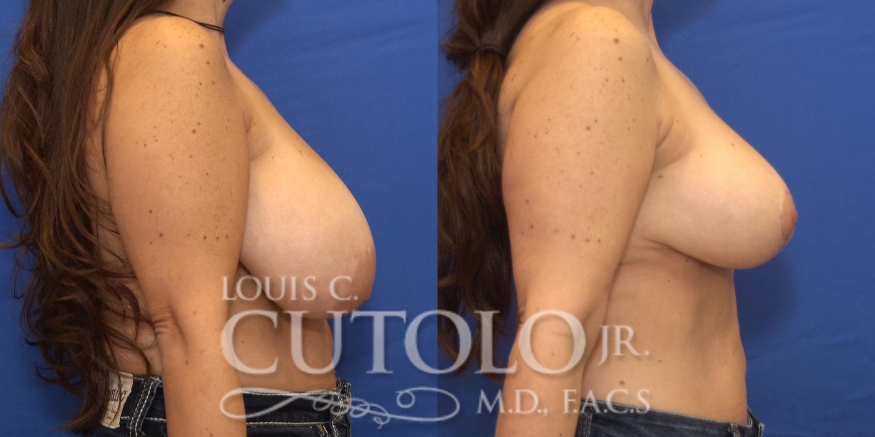 Before & After Breast Reduction Case 168 View #5 View in Brooklyn, Staten Island, Queens, NY