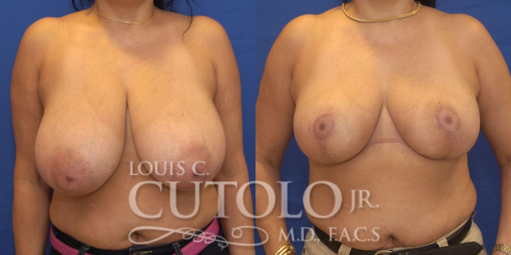 Before & After Breast Reduction Case 171 View #1 View in Brooklyn, Staten Island, Queens, NY