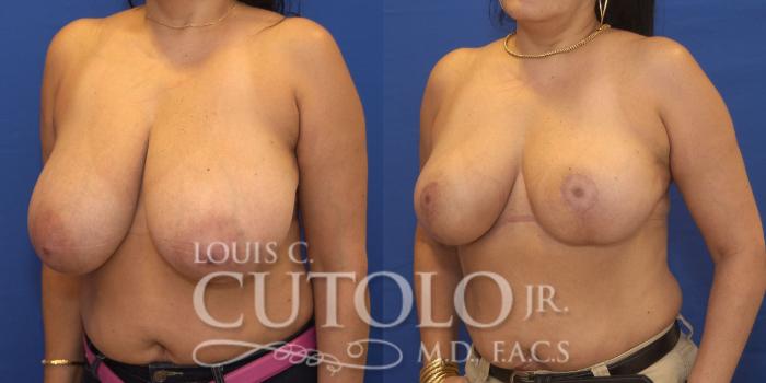 Before & After Breast Reduction Case 171 View #2 View in Brooklyn, Staten Island, Queens, NY