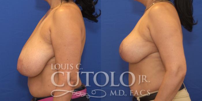 Before & After Breast Reduction Case 171 View #3 View in Brooklyn, Staten Island, Queens, NY