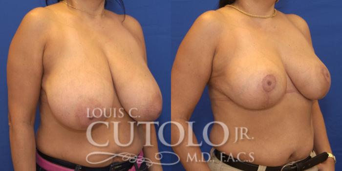 Before & After Breast Reduction Case 171 View #4 View in Brooklyn, Staten Island, Queens, NY