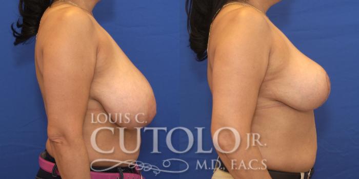 Before & After Breast Reduction Case 171 View #5 View in Brooklyn, Staten Island, Queens, NY