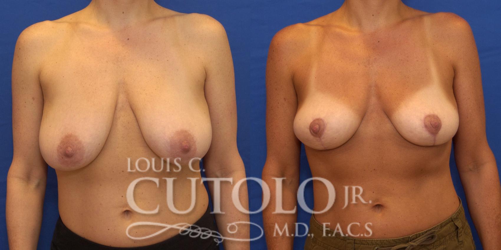 Before & After Breast Reduction Case 195 View #1 View in Brooklyn, Staten Island, Queens, NY