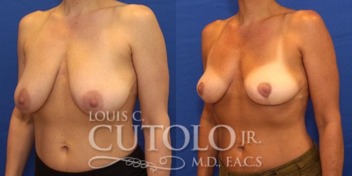 Before & After Breast Reduction Case 195 View #2 View in Brooklyn, Staten Island, Queens, NY