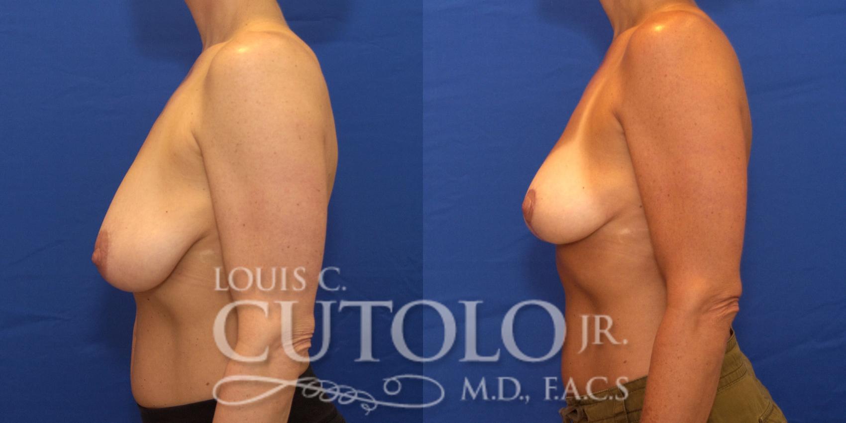 Before & After Breast Reduction Case 195 View #3 View in Brooklyn, Staten Island, Queens, NY