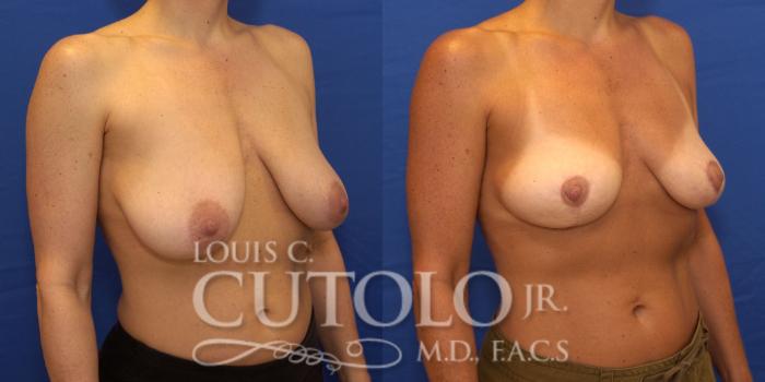 Before & After Breast Reduction Case 195 View #4 View in Brooklyn, Staten Island, Queens, NY