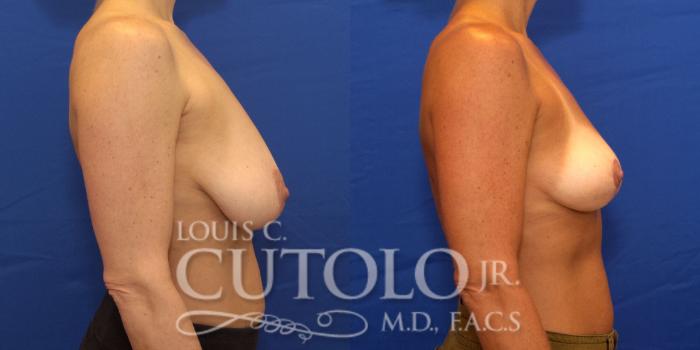 Before & After Breast Reduction Case 195 View #5 View in Brooklyn, Staten Island, Queens, NY