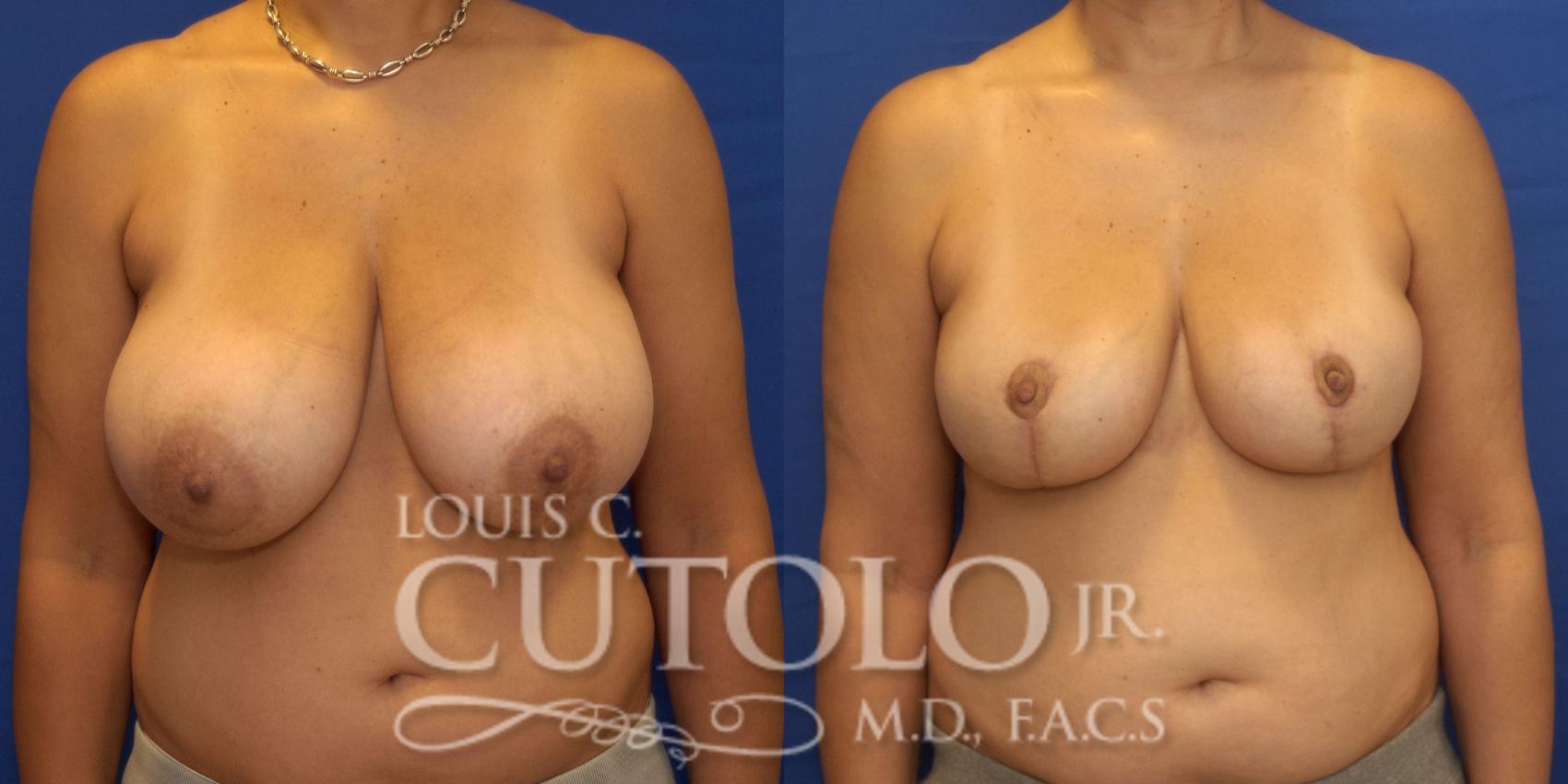 Before & After Breast Reduction Case 238 Front View in Brooklyn, Staten Island, Queens, NY