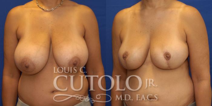 Before & After Breast Reduction Case 238 Left Oblique View in Brooklyn, Staten Island, Queens, NY