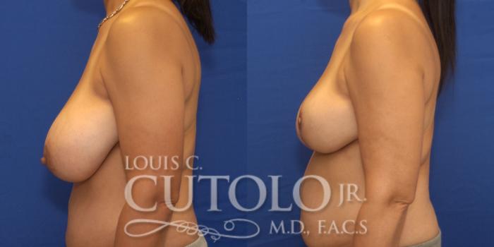 Before & After Breast Reduction Case 238 Left Side View in Brooklyn, Staten Island, Queens, NY