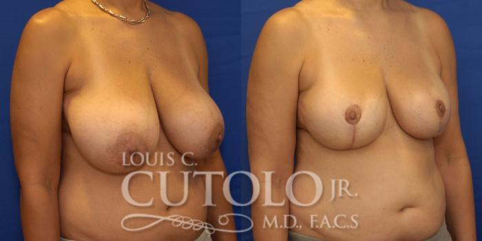 Before & After Breast Reduction Case 238 Right Oblique View in Brooklyn, Staten Island, Queens, NY