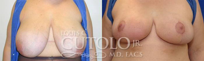Before & After Breast Reduction Case 24 View #1 View in Brooklyn, Staten Island, Queens, NY