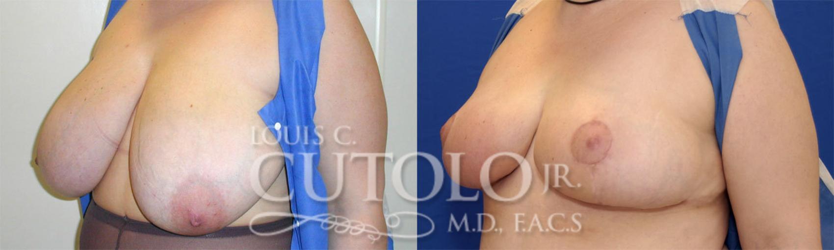 Before & After Breast Reduction Case 24 View #2 View in Brooklyn, Staten Island, Queens, NY