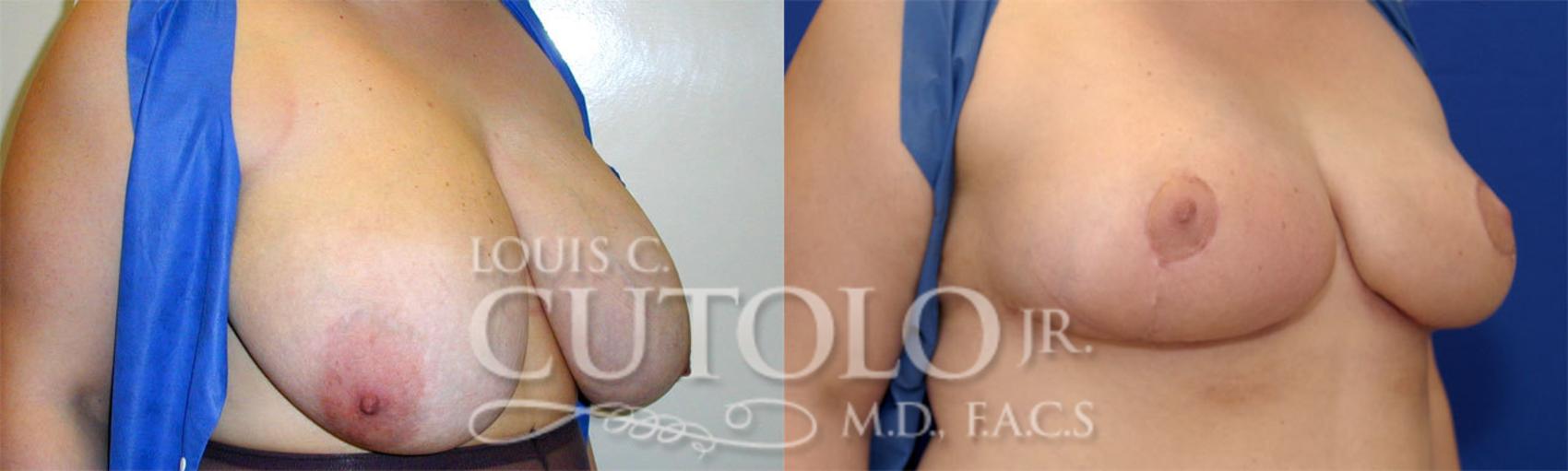 Before & After Breast Reduction Case 24 View #3 View in Brooklyn, Staten Island, Queens, NY