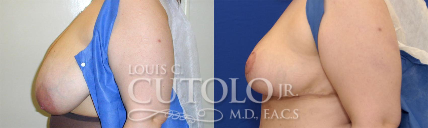 Before & After Breast Reduction Case 24 View #4 View in Brooklyn, Staten Island, Queens, NY