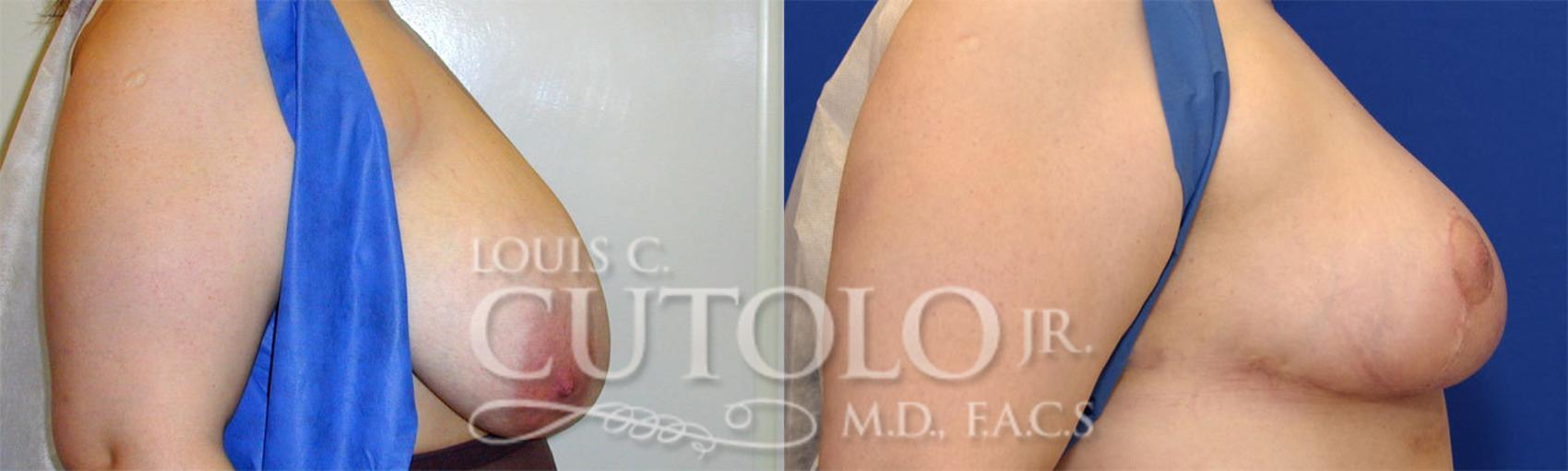 Before & After Breast Reduction Case 24 View #5 View in Brooklyn, Staten Island, Queens, NY