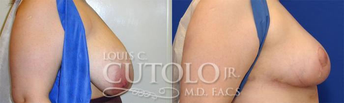 Before & After Breast Reduction Case 24 View #5 View in Brooklyn, Staten Island, Queens, NY