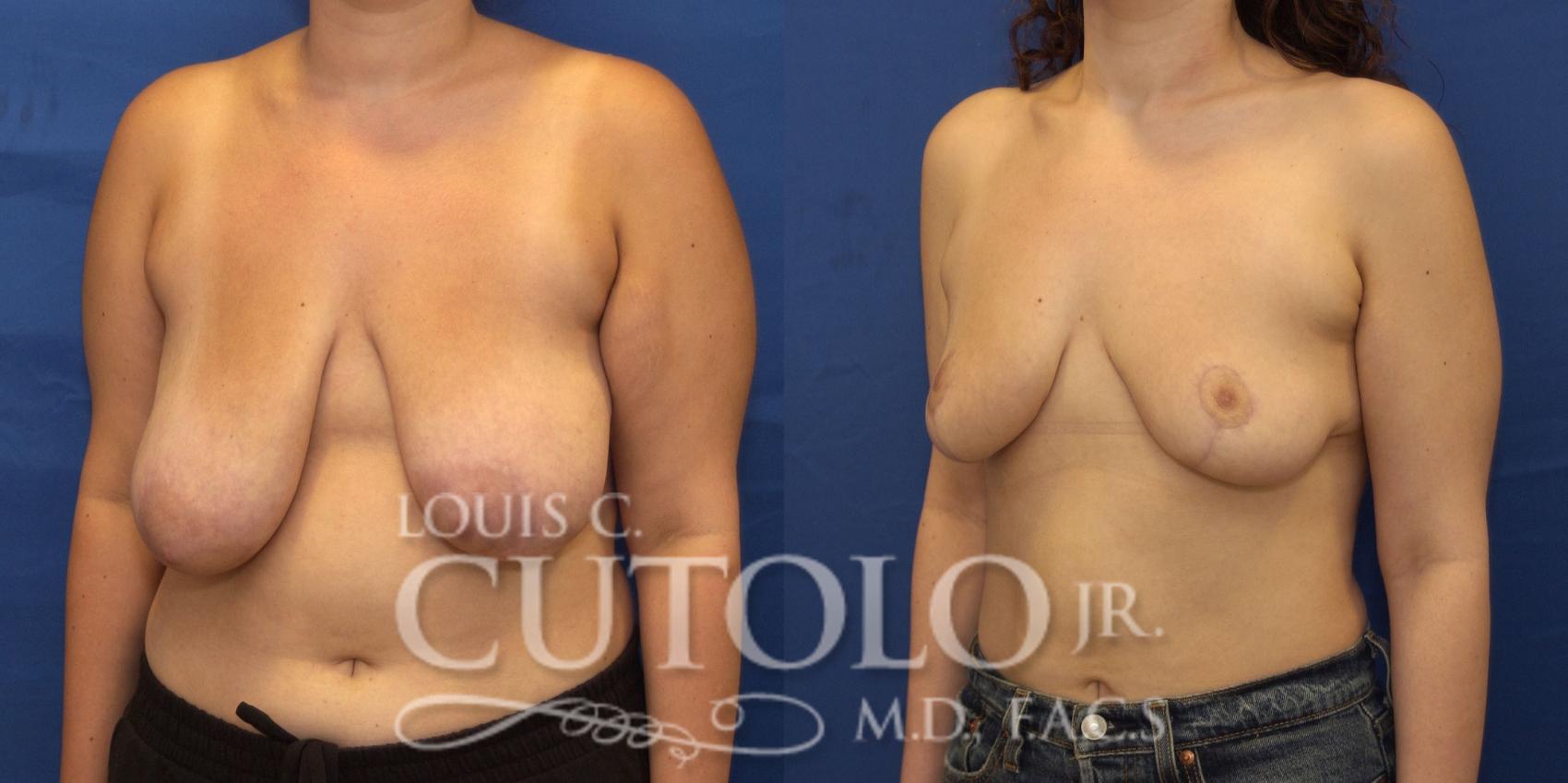 left oblique pre op 