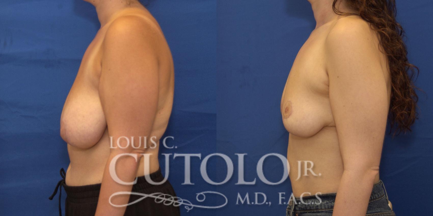 left lateral pre op 
