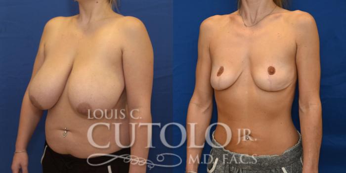 Before & After Breast Reduction Case 262 Left Oblique View in Brooklyn, Staten Island, Queens, NY