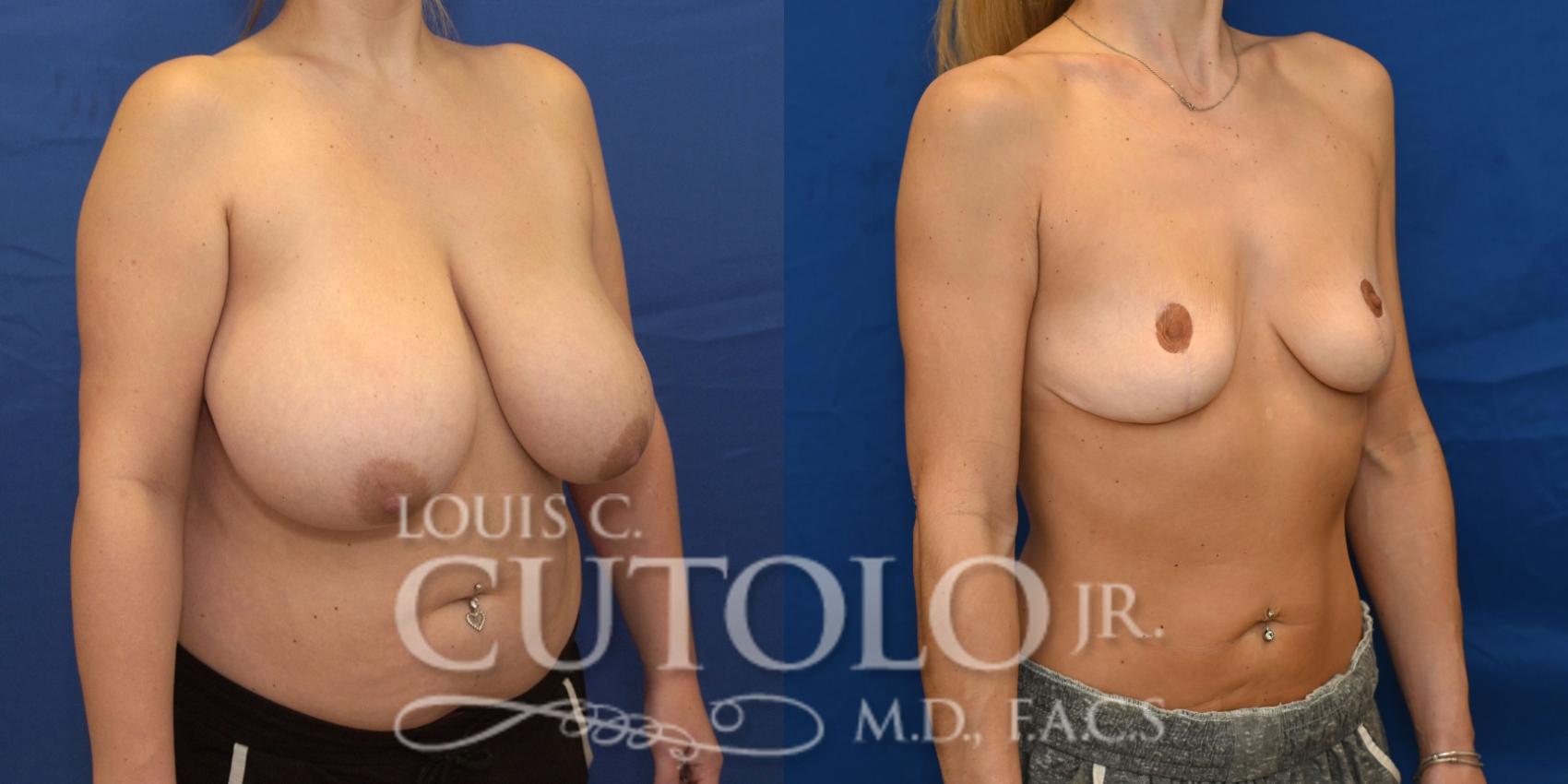 Right Oblique Before