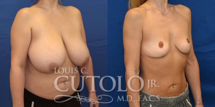 Right Oblique Before