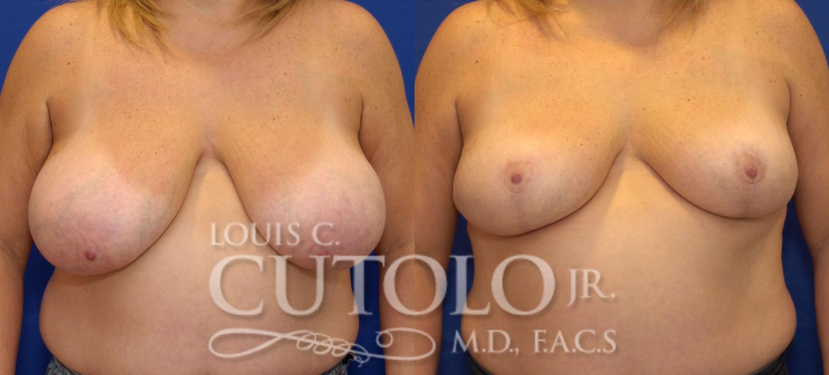 Before & After Breast Reduction Case 33 View #1 View in Brooklyn, Staten Island, Queens, NY