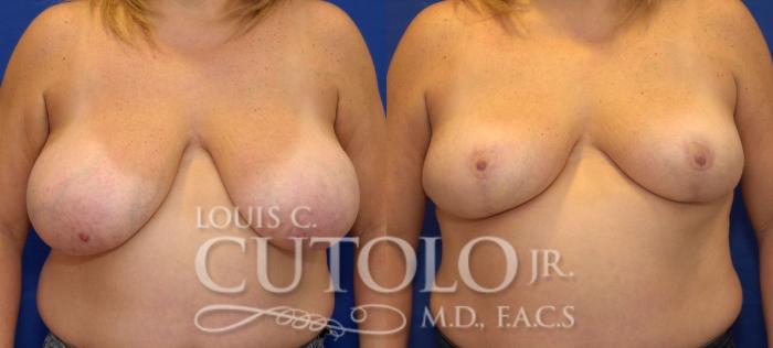 Before & After Breast Reduction Case 33 View #1 View in Brooklyn, Staten Island, Queens, NY