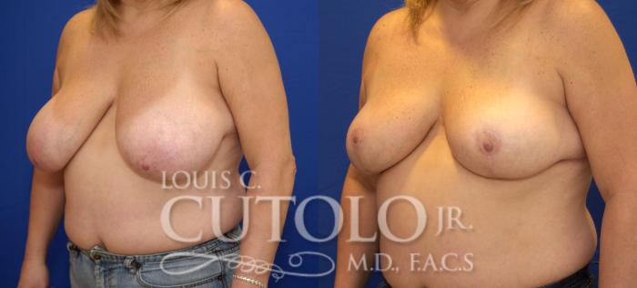 Before & After Breast Reduction Case 33 View #2 View in Brooklyn, Staten Island, Queens, NY