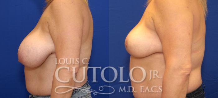 Before & After Breast Reduction Case 33 View #3 View in Brooklyn, Staten Island, Queens, NY