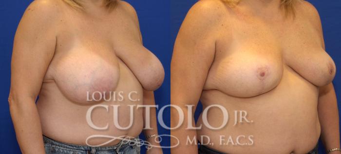 Before & After Breast Reduction Case 33 View #4 View in Brooklyn, Staten Island, Queens, NY