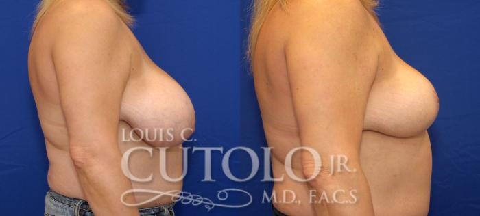 Before & After Breast Reduction Case 33 View #5 View in Brooklyn, Staten Island, Queens, NY