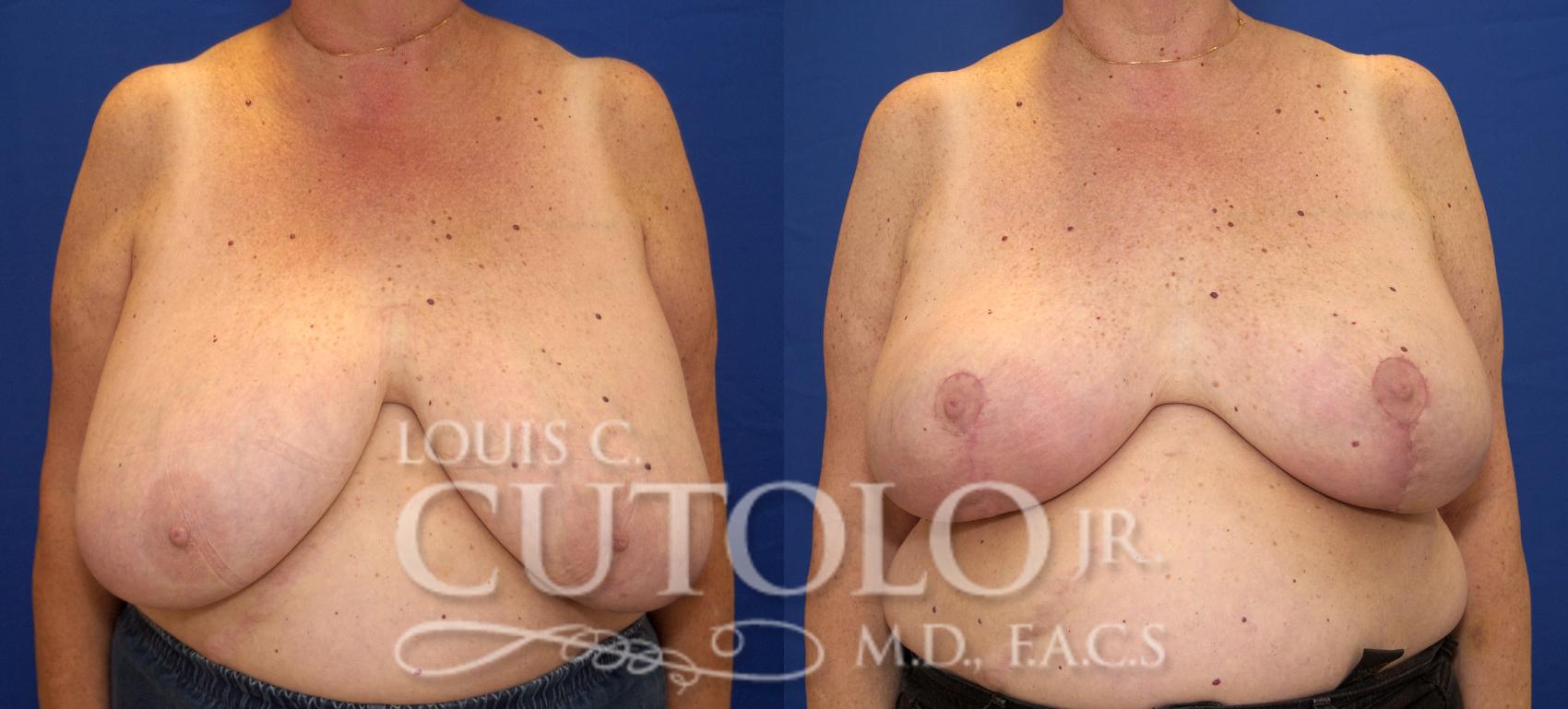 Before & After Breast Reduction Case 69 View #1 View in Brooklyn, Staten Island, Queens, NY