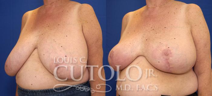 Before & After Breast Reduction Case 69 View #2 View in Brooklyn, Staten Island, Queens, NY