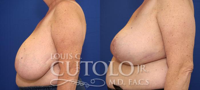Before & After Breast Reduction Case 69 View #3 View in Brooklyn, Staten Island, Queens, NY