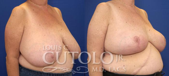 Before & After Breast Reduction Case 69 View #4 View in Brooklyn, Staten Island, Queens, NY