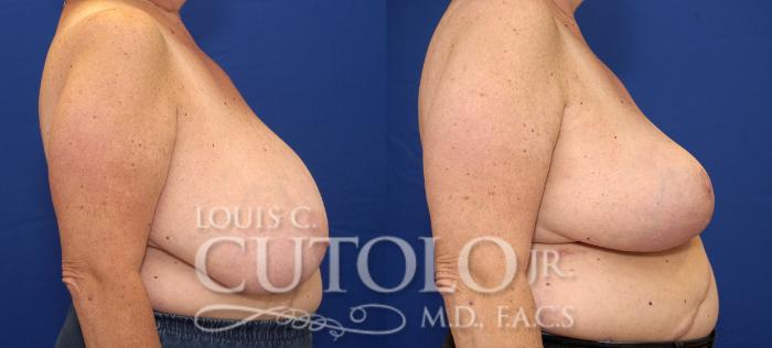 Before & After Breast Reduction Case 69 View #5 View in Brooklyn, Staten Island, Queens, NY
