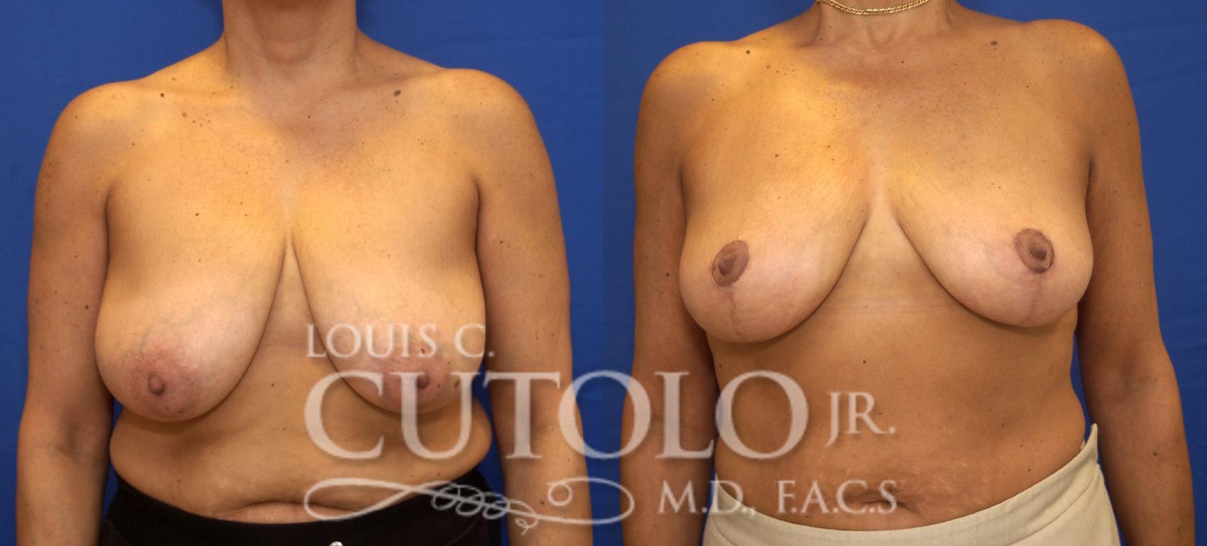 Before & After Breast Reduction Case 82 View #1 View in Brooklyn, Staten Island, Queens, NY