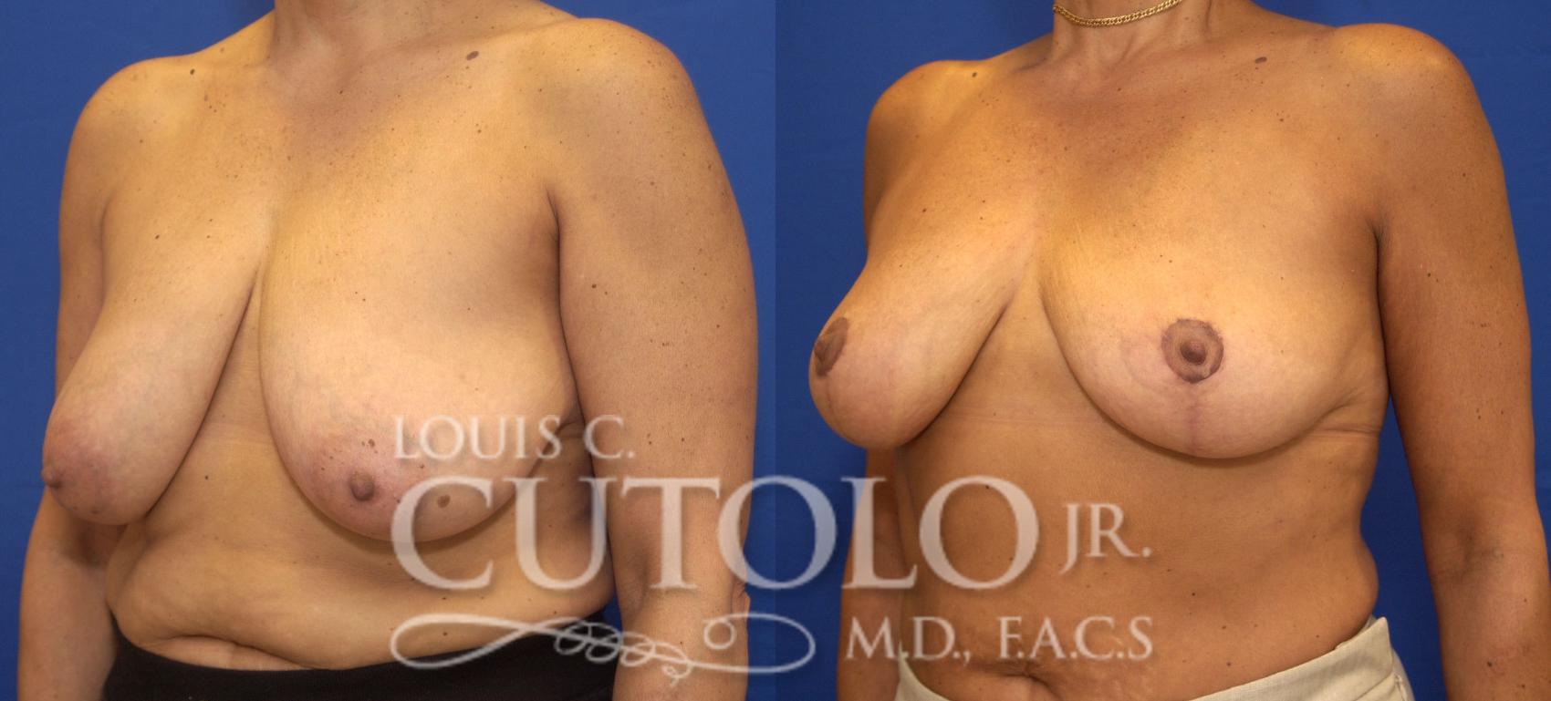 Before & After Breast Reduction Case 82 View #2 View in Brooklyn, Staten Island, Queens, NY