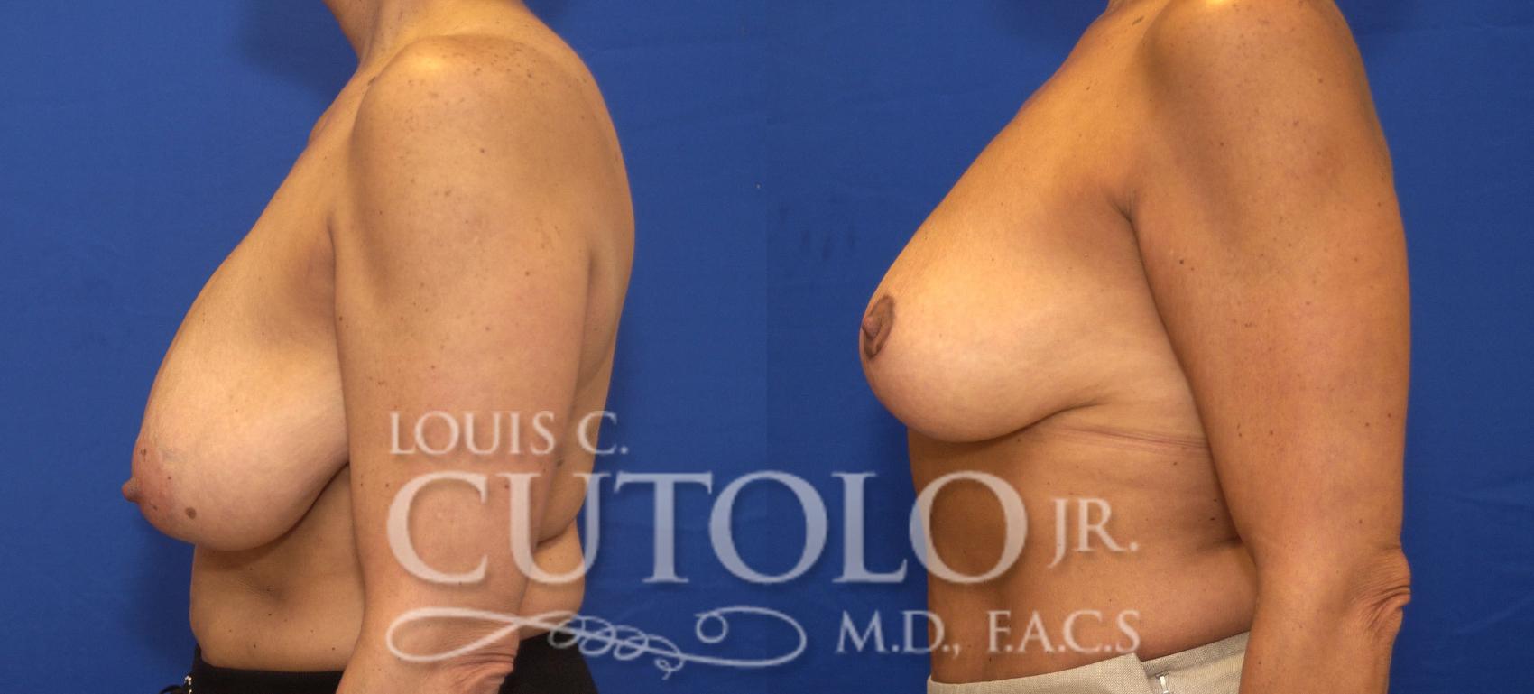 Before & After Breast Reduction Case 82 View #3 View in Brooklyn, Staten Island, Queens, NY